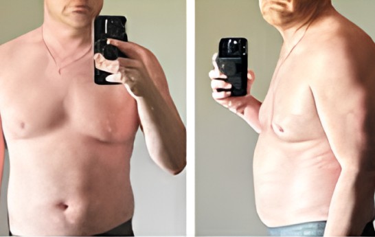 An Axiom patient photographed before and after a medical weight loss program
