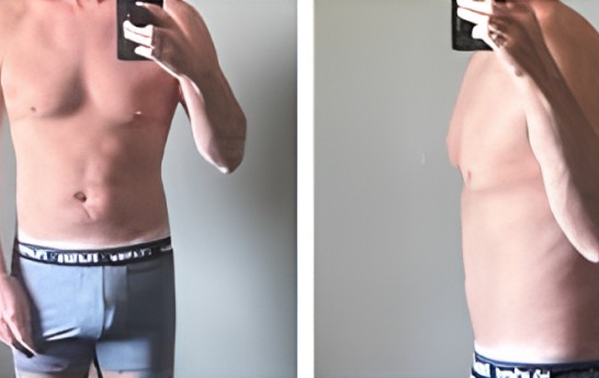 A second Axiom patient photographed before and after a medical weight loss program